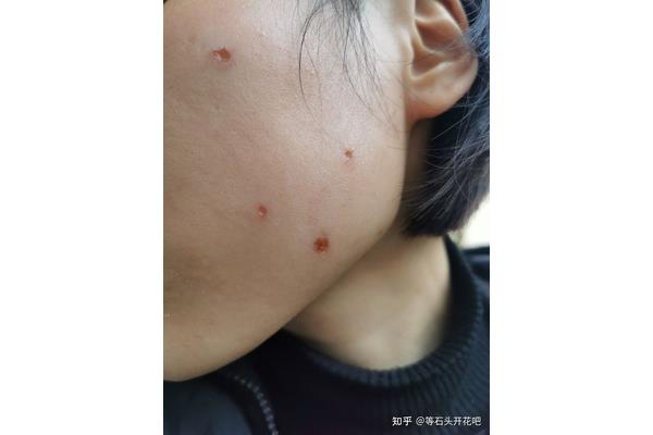 Spot 点痣后几天可以洗脸,祛痣后多久可以洗脸?